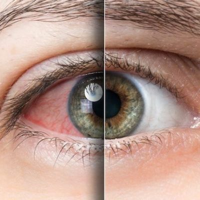 راه های پیشگیری از خشکی چشم و درمانهای خانگی خشکی چشم