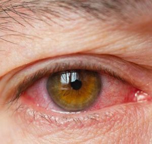 علائم خشکی چشم و درمانهای دارویی خشکی چشم